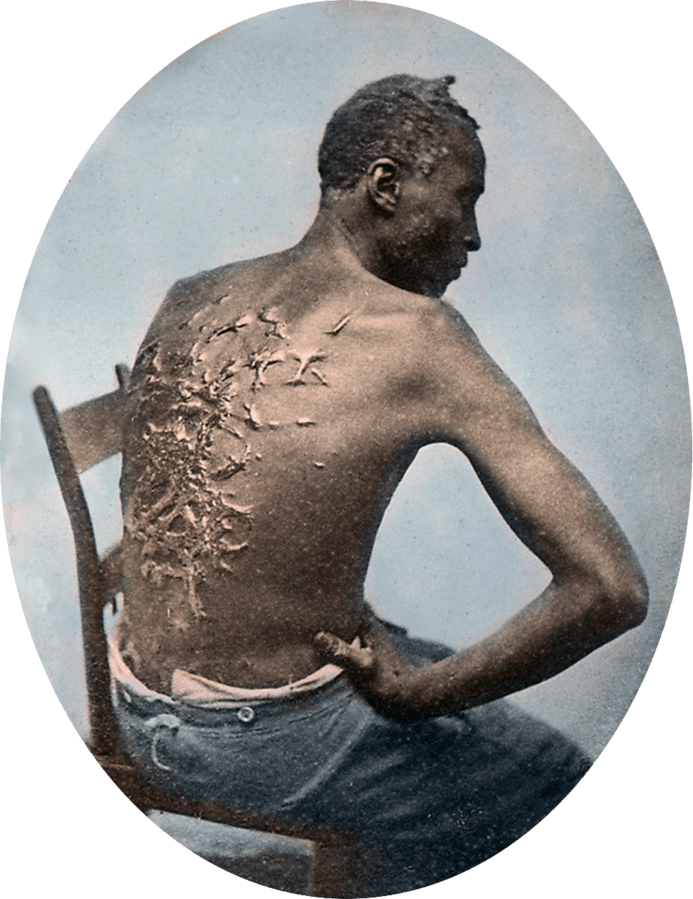 Gordon,_scourged_back,_colored_slide_2